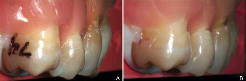 Формирование клиновидного дефекта за счёт абразивного действия чистки зубов in vitro.jpg