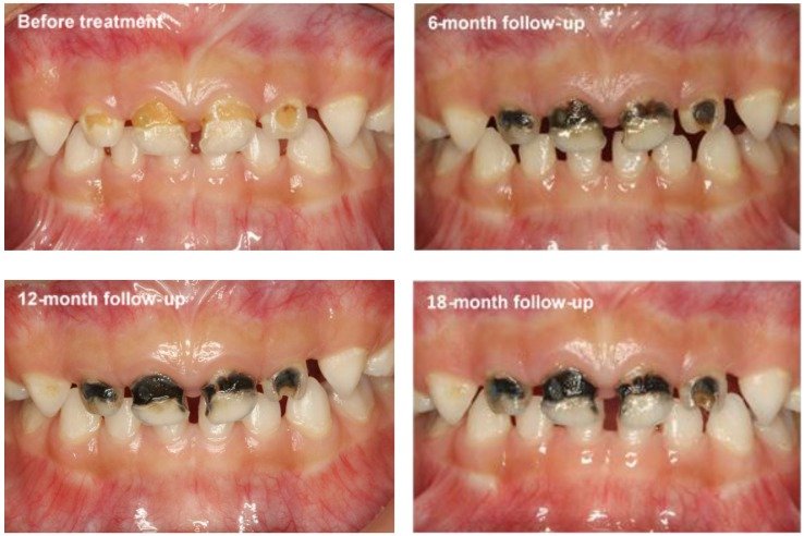 Зубы после обработки нитратом серебра
