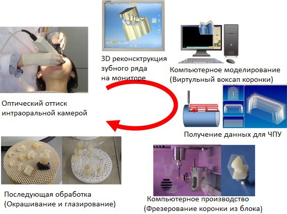 Рис. 1. Процесс цифрового изготовления зубных протезов